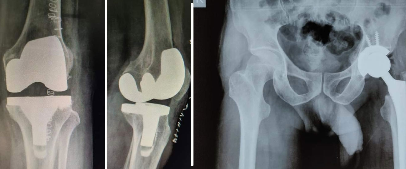 Basu's Clinic Leads the Way in Hip & Knee Replacement Surgeries